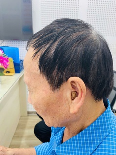 Máy trợ thính siêu nhỏ trong tai CIC 