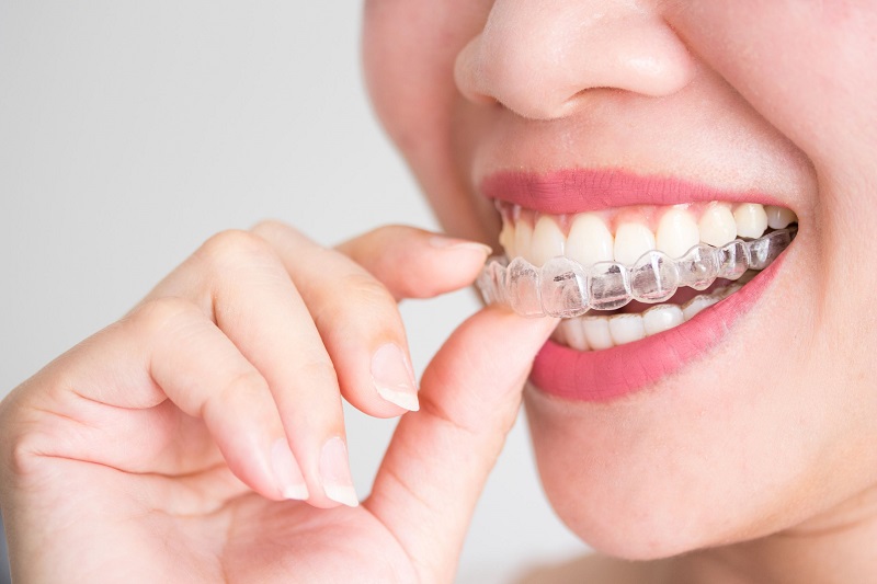 Quy trình niềng răng invisalign và niềng răng có tốt không
