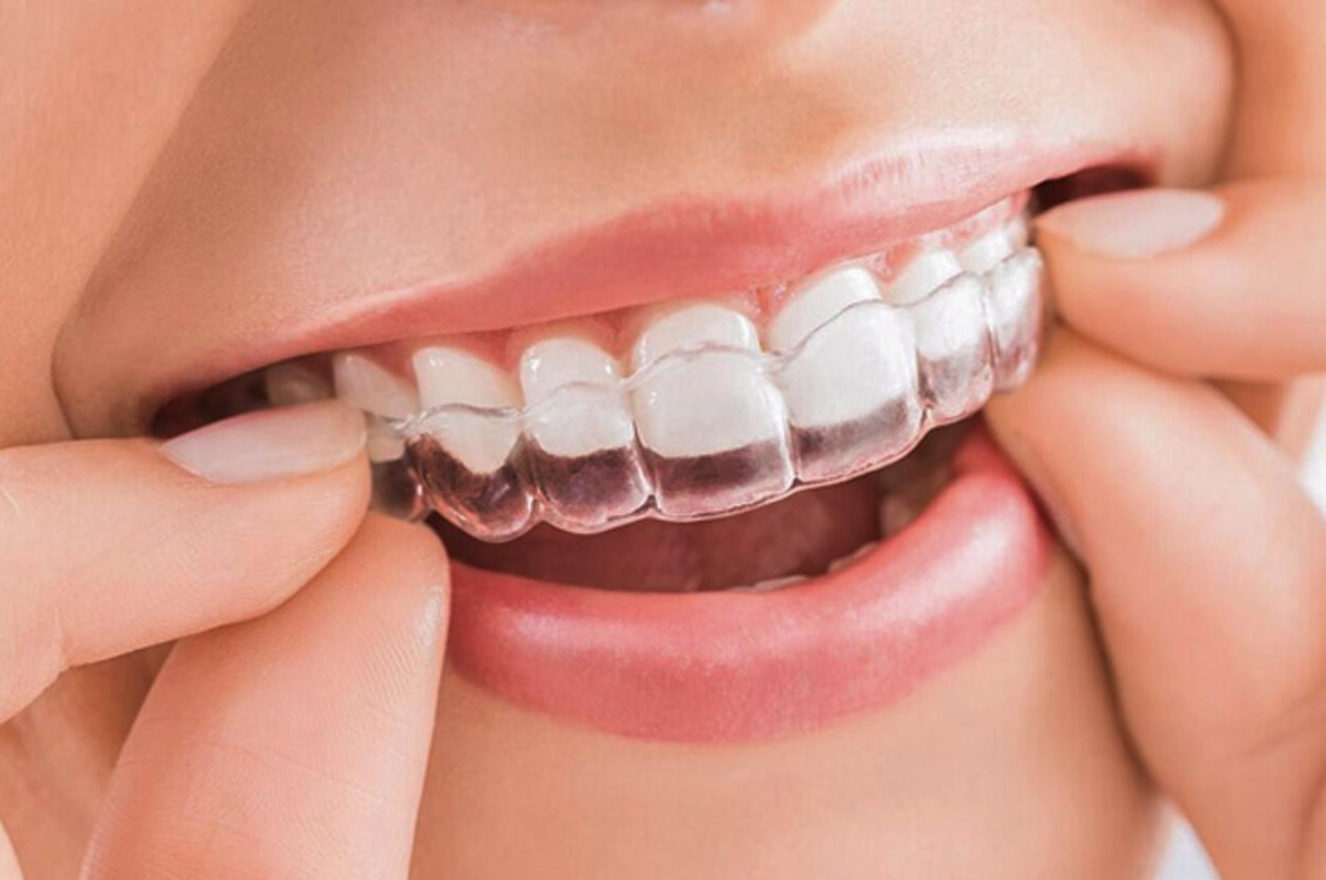 1 Quy trình niềng răng invisalign và niềng răng có tốt không