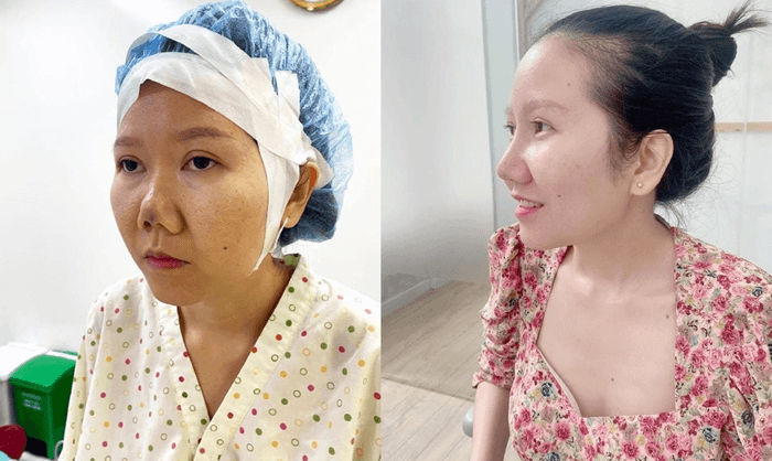 2 Bác sĩ Nhạn mát tay sửa lại mũi hỏng
