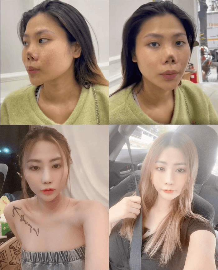 3 Bác sĩ Nhạn mát tay sửa lại mũi hỏng