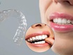 Niềng răng thẩm mỹ   giải pháp mang đến nụ cười đẹp cho mọi...