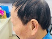 Máy trợ thính siêu nhỏ trong tai CIC 