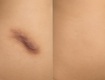 Giải pháp che sẹo thâm bằng kỹ thuật xăm màu da  Skin Camouflage Tattoo : Bí quyết...