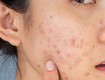 Da đang có thâm mụn, làm sao nhận biết hàng rào bảo vệ da bị tổn thương 