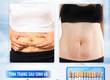 Sau Sinh Có Nên Hút Mỡ Bụng Không 