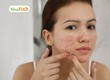 Tinh Dầu Tràm Trà Trị Mụn Hiệu Quả   Bí Quyết Chăm Sóc Da 