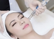 5 Lưu Ý Về Tần Suất Laser Toning Giúp Da Phục Hồi Tốt Nhất 