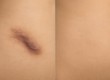 Giải pháp che sẹo thâm bằng kỹ thuật xăm màu da  Skin Camouflage Tattoo : Bí quyết...