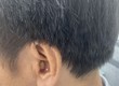 Máy trợ thính trong tai CIC, máy trợ thính thẩm mỹ 