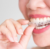 Quy trình niềng răng invisalign và niềng răng có tốt không