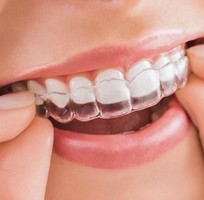 1 Quy trình niềng răng invisalign và niềng răng có tốt không