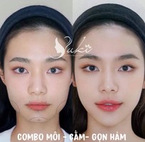 3 Tiêm Filler Môi Đà Nẵng tại Thanh Yuki Beauty Center