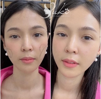 4 Tiêm Filler Môi Đà Nẵng tại Thanh Yuki Beauty Center