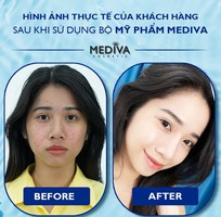 Hyalu B5 Cream    Kem Siêu Dưỡng Ẩm Da  được mong chờ nhất trong năm 2023 đã trình làng rồi các nàng