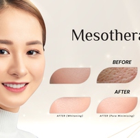 1 Tiêm Meso và Tiêm B.A.P khác nhau như thế nào