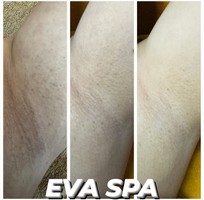 1 Ủ Bắn Trắng Nách tại Eva Spa Cần Thơ, trắng da, sáng mịn, hết thâm 1 Ủ Bắn Trắng Nách tại Eva Spa Cần Thơ, trắng da, sáng mịn, hết thâm