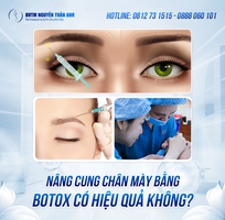 Nâng cung chân mày bằng botox