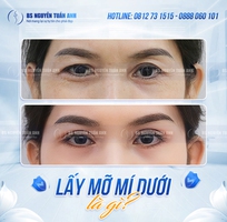 Hiểu rõ nguyên nhân hình thành quầng thâm dưới mắt