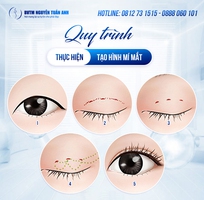 Lợi ích nổi bật của cắt mí mini deep