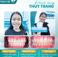 Niềng răng có giúp mặt hết lệch không