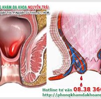 1 Chữa trị bệnh trĩ nội độ 4 bằng cách nào tốt