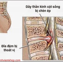 Thoát vị đĩa đệm cấy chỉ Minh Quang trị bệnh