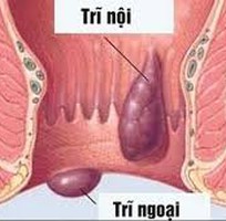 2 Chữa trị Trĩ Nội   Trĩ ngoại   Tinh hoàn không đều   Sa dạ con tại Hà nội