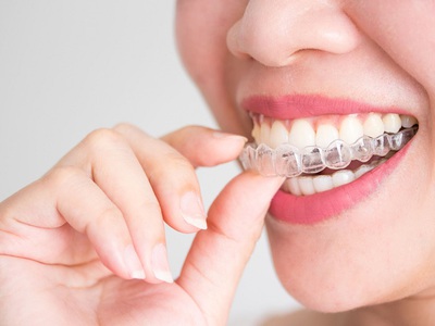 Quy trình niềng răng invisalign và niềng răng có tốt không 0