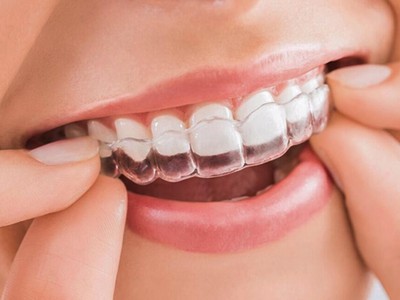 Quy trình niềng răng invisalign và niềng răng có tốt không 1