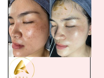Kem mờ nám amay nhật bản, mỹ phẩm amay nhật bản, kem antirosine amay 2