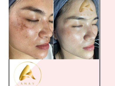 Kem mờ nám amay nhật bản, mỹ phẩm amay nhật bản, kem antirosine amay 5