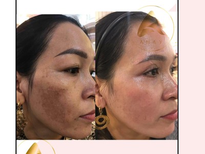Kem mờ nám amay nhật bản, mỹ phẩm amay nhật bản, kem antirosine amay 4
