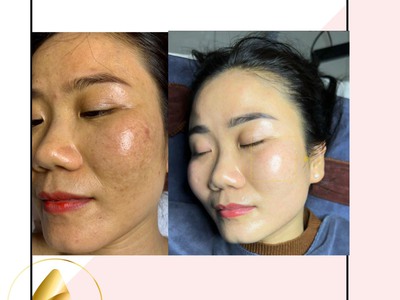 Kem mờ nám amay nhật bản, mỹ phẩm amay nhật bản, kem antirosine amay 3