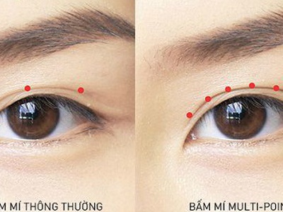 Bấm mí multi point là gì  Có tốt không 1
