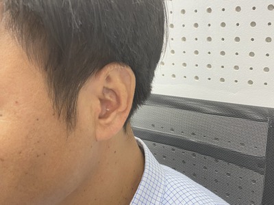 Máy trợ thính siêu nhỏ CIC - Máy trợ thính Tâm An Hải Phòng 3