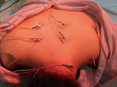 Bs vật lý trị liệu, châm cứu chữa liệt tại nhà TP HCM 0