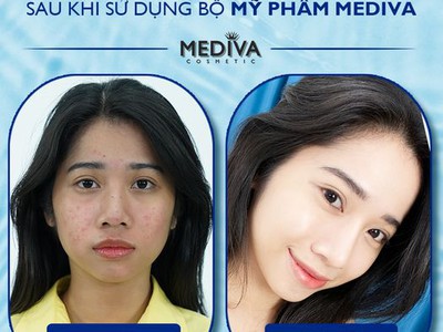 Hyalu B5 Cream    Kem Siêu Dưỡng Ẩm Da  được mong chờ nhất trong năm 2023 đã trình làng rồi các nàng 0