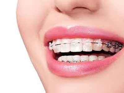 Niềng răng chỗ nào tốt 1