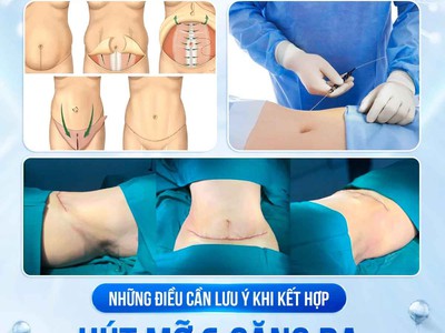 Kết hợp hút mỡ   căng da có nên hay không 0