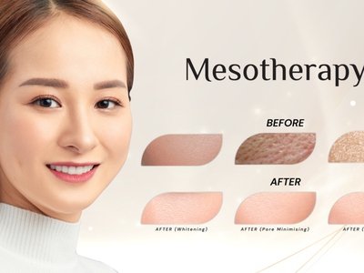Tiêm Meso và Tiêm B.A.P khác nhau như thế nào 1