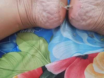 Chia sẻ kinh nghiệm lột da bàn chân  Foot Peeling 4