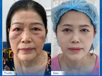 Căng Da Mặt Phẫu Thuật vs. Không Phẫu Thuật: Lựa Chọn Nào Tiết Kiệm Hơn 0