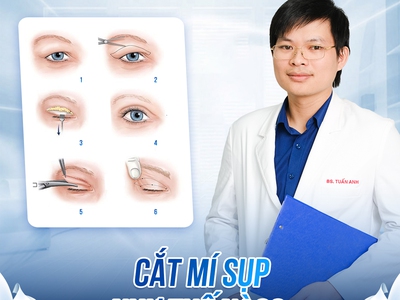 Cắt mí có thay đổi vận mệnh không 0