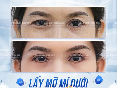 Hiểu rõ nguyên nhân hình thành quầng thâm dưới mắt 0