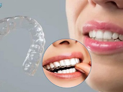 Niềng răng thẩm mỹ - giải pháp mang đến nụ cười đẹp cho mọi lứa tuổi 0