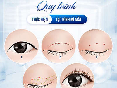 Lợi ích nổi bật của cắt mí mini deep 0