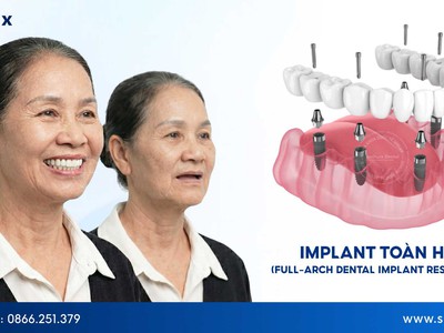 Những trường hợp nào được khuyên dùng Implant toàn hàm 0