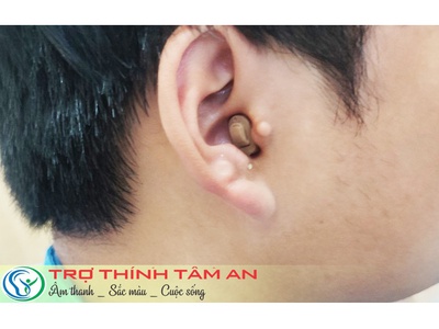 Insio 2NX CIC - Giải pháp trợ thính kín đáo cho người yêu sự tinh tế 1