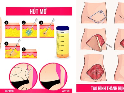 Tạo hình thành bụng khác gì hút mỡ bụng 0